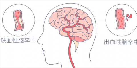 牢記兩大口訣，盡早識別急性腦血管疾病——“腦卒中”