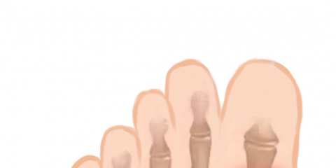 避雷！這六大痛風(fēng)的誤區(qū)別再犯了！