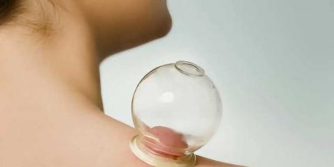 拔罐會(huì)導(dǎo)致貧血嗎 拔罐的注意事項(xiàng)